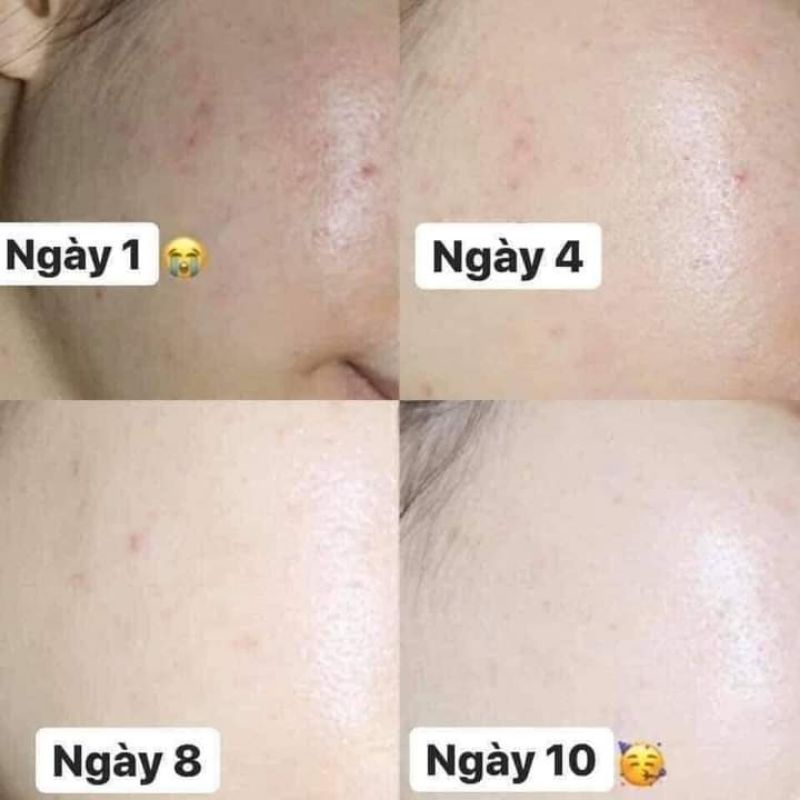 Spot chấm mụn Ac care