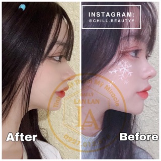 [HOT] Tinh chất nâng mũi Hàn Quốc