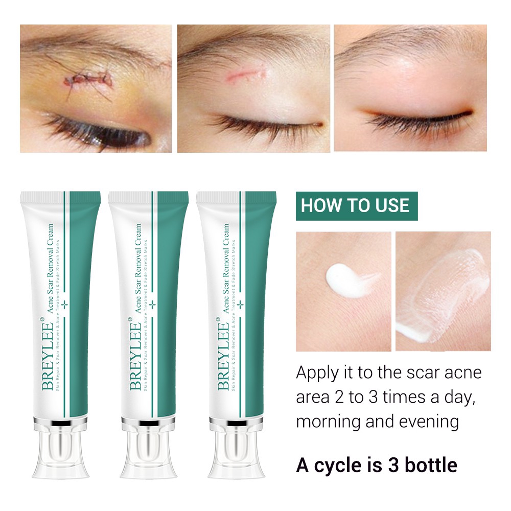 Kem Hỗ Trợ Giảm Sẹo Do Mụn BREYLEE Làm Sáng Da 30g
