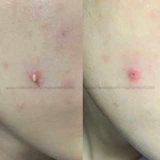 Miếng dán mụn COSRX Acne Pimple Master Patch 2 loại đỏ, đen