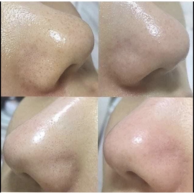 Dung Dịch Ủ Mụn Đầu Đen SPA MEDIPEEL EXTRA SUPER 9+