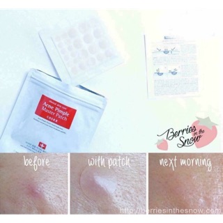 miếng dán mụn coxs ,nhanh xẹp mụn chống vi khuẩn gây mụn