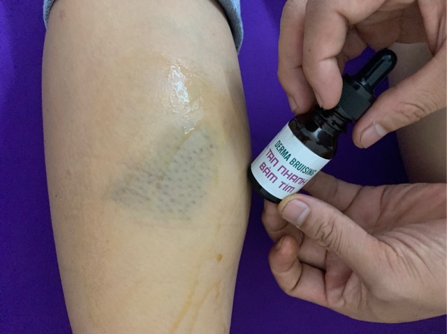 Gel bôi tan nhanh bầm tím - giảm sưng nề do chấn thương-sau thẩm mỹ DERMA BRUISING
