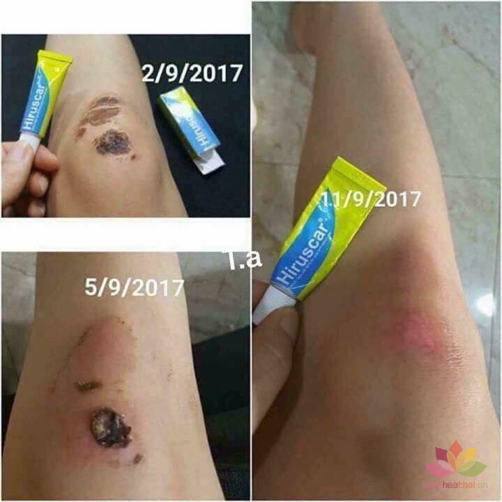 Gel làm mờ şẹo Hirucas -7g (Thailand)