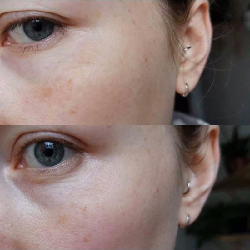 Kem hỗ trợ giảm mụn Azclear Action Lotion 25gr (Azelaic acid) | BigBuy360 - bigbuy360.vn