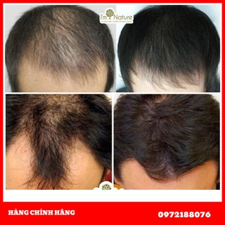 {Dùng Là Thích}Dầu Gội Cặp Trị Rụng Tóc Mọc Tóc Im Nature Size 100ml