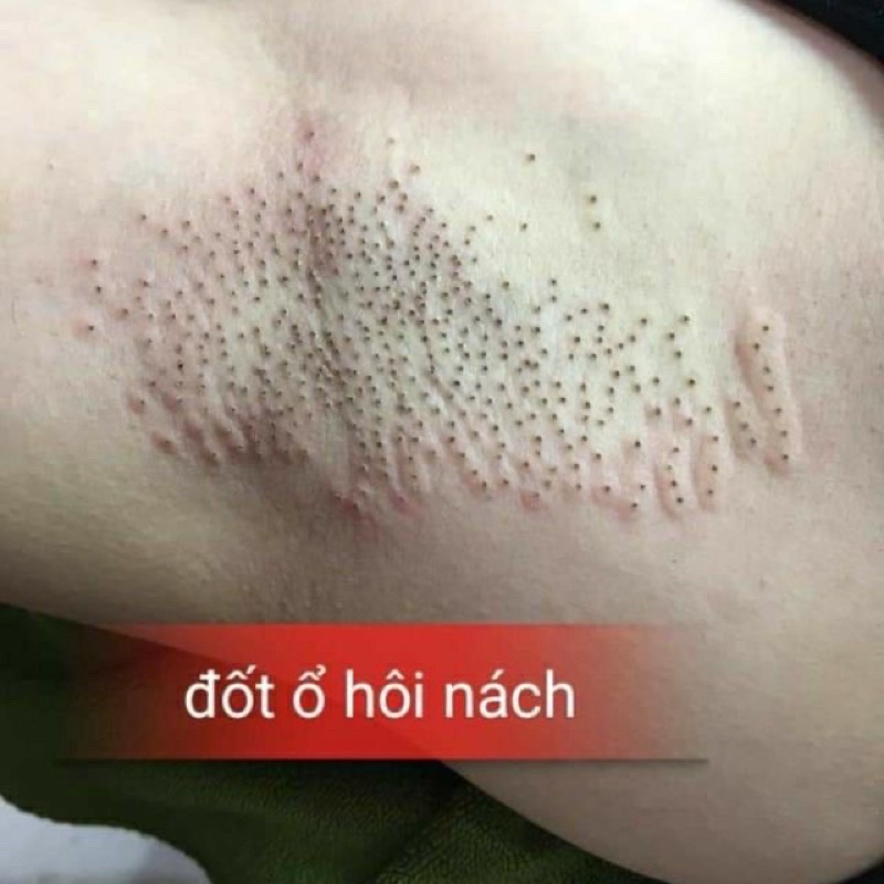 Hôi Nách - Hôi Chân dạng bột bôi sau khi đốt ổ hôi nách tại spa