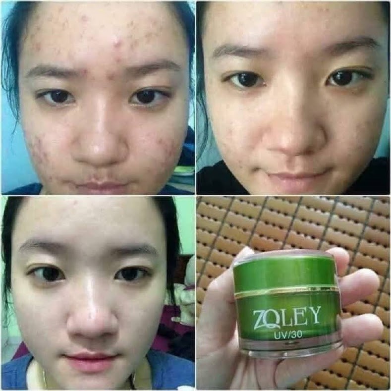 Kem Zoley Xanh 10g_Ngừa Mụn,Vết Thâm,Dưỡng Trắng Da