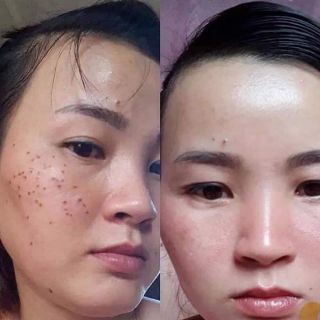 Chấm tàn nhang sẹo lõm đồi mồi nốt ruồi sẹo lồi Yody White Phương Anh