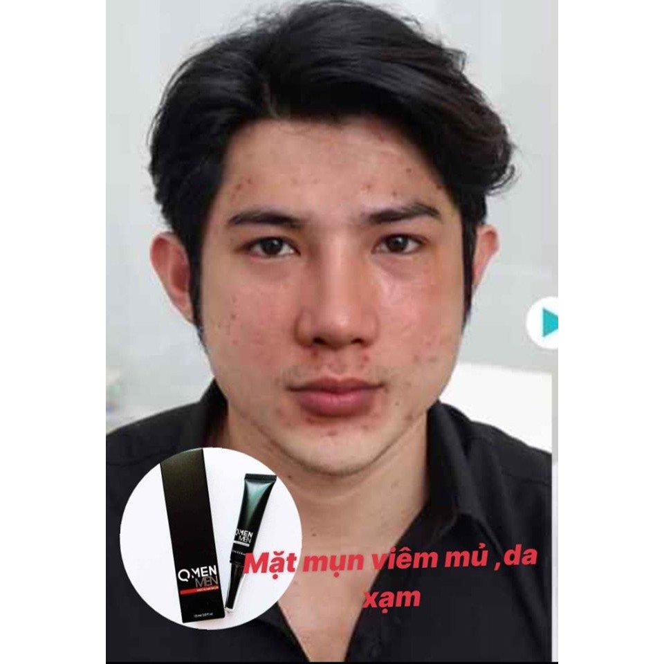 Combo trị mụn QMEN - WHA Serum + Tea Tree Oil + Magic Sun Pray