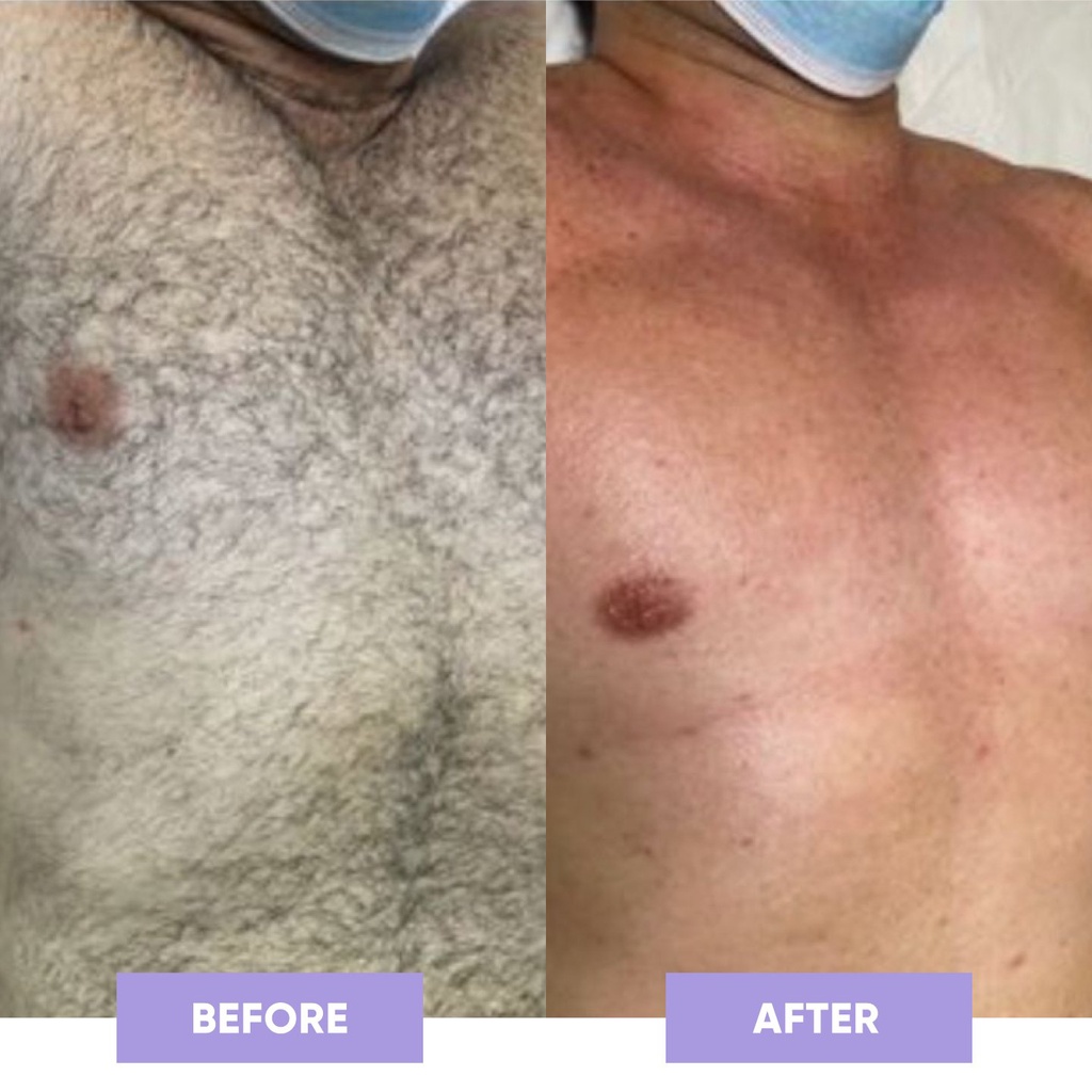 US-UK  Đá tẩy lông không đau Nano-Crystalline Misglo cao cấp Full Box