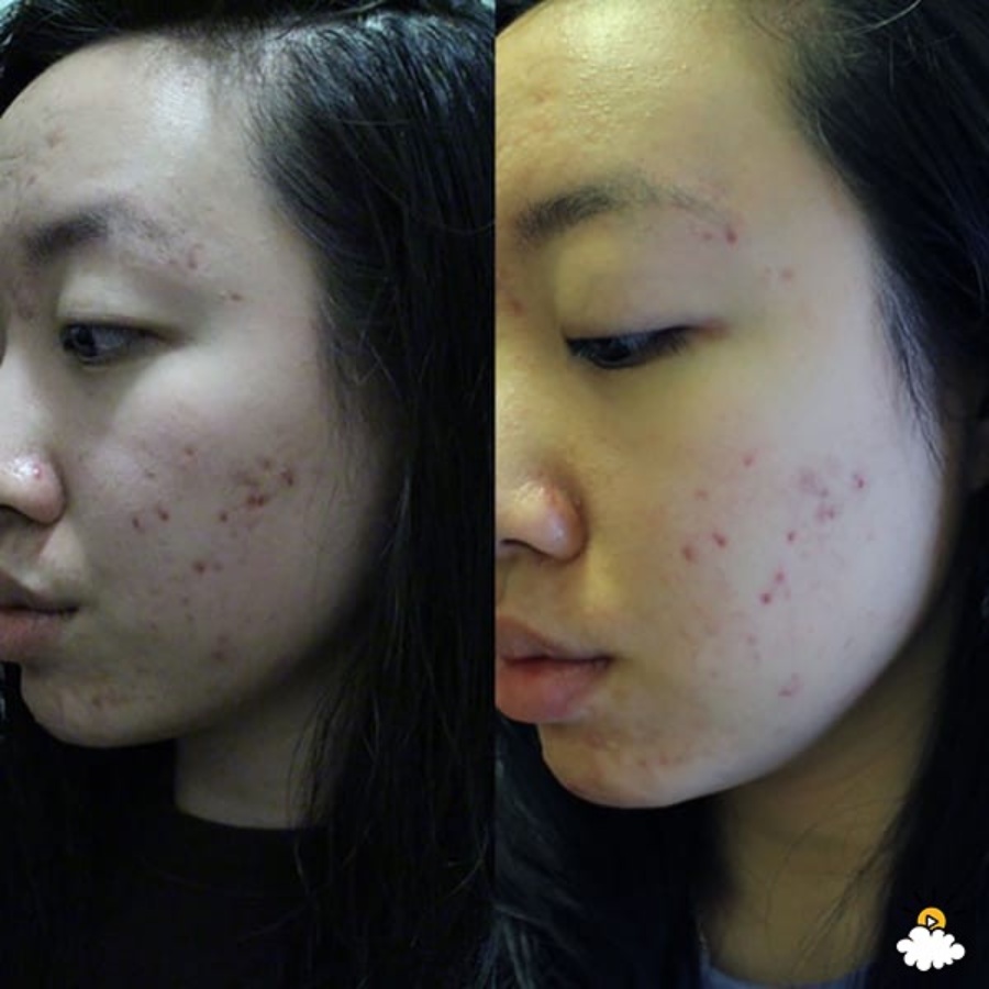 Kem ngừa mụn Benzac AC Benzoyl Peroxide - Galderma