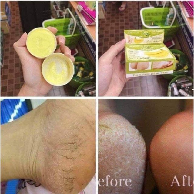 Kem Chuyên Trị Nứt Gót Chân Chuối