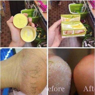 Kem Chuyên Trị Nứt Gót Chân Chuối