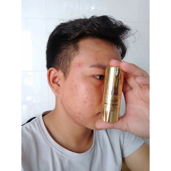 Serum Ngừa Mụn Napoli Hải Âu Việt