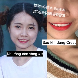 Dán Trắng Răng Crest 5 miếng