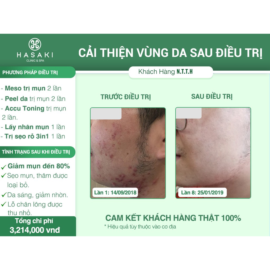 HCM [Voucher] - Combo Lấy Mụn + Đắp Mặt Nạ + Nằm Đèn Tại Hasaki Clinic & Spa