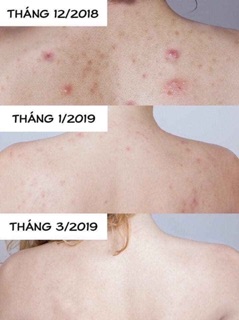 Xà phòng trị mụn lưng For Back