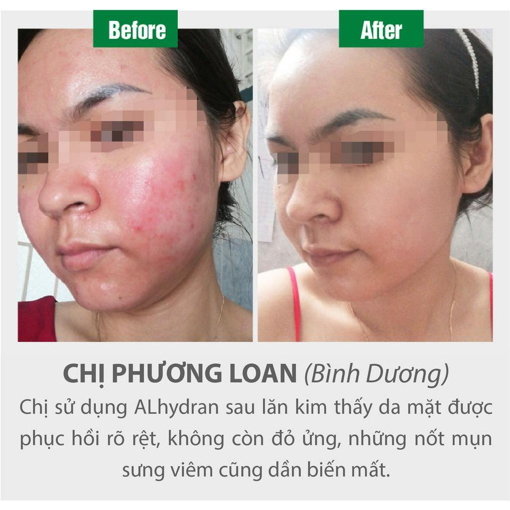 Kem dưỡng ẩm, phục hồi da sau xâm lấn Alhydran 15ml - chuyên gia tin dùng