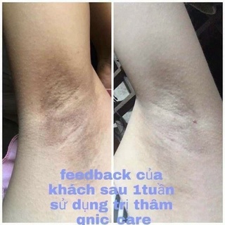 [ Mẫu mới ] KEM GIẢM THÂM QNIC 15Gram Hỗ Trợ Giảm Thâm Dưỡng Da Body