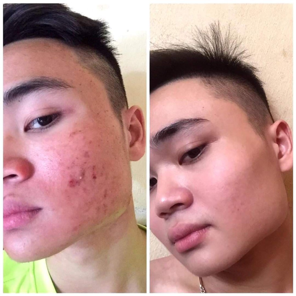 Serum Trị Mụn Cao Cấp Rulya Silk Anti Acnes | BigBuy360 - bigbuy360.vn