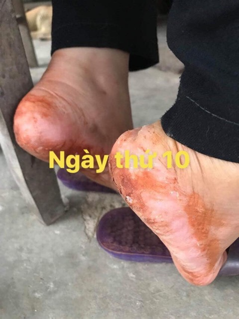 Bôi Nứt Gót Chân kiểu gì cũng hết nứt | BigBuy360 - bigbuy360.vn