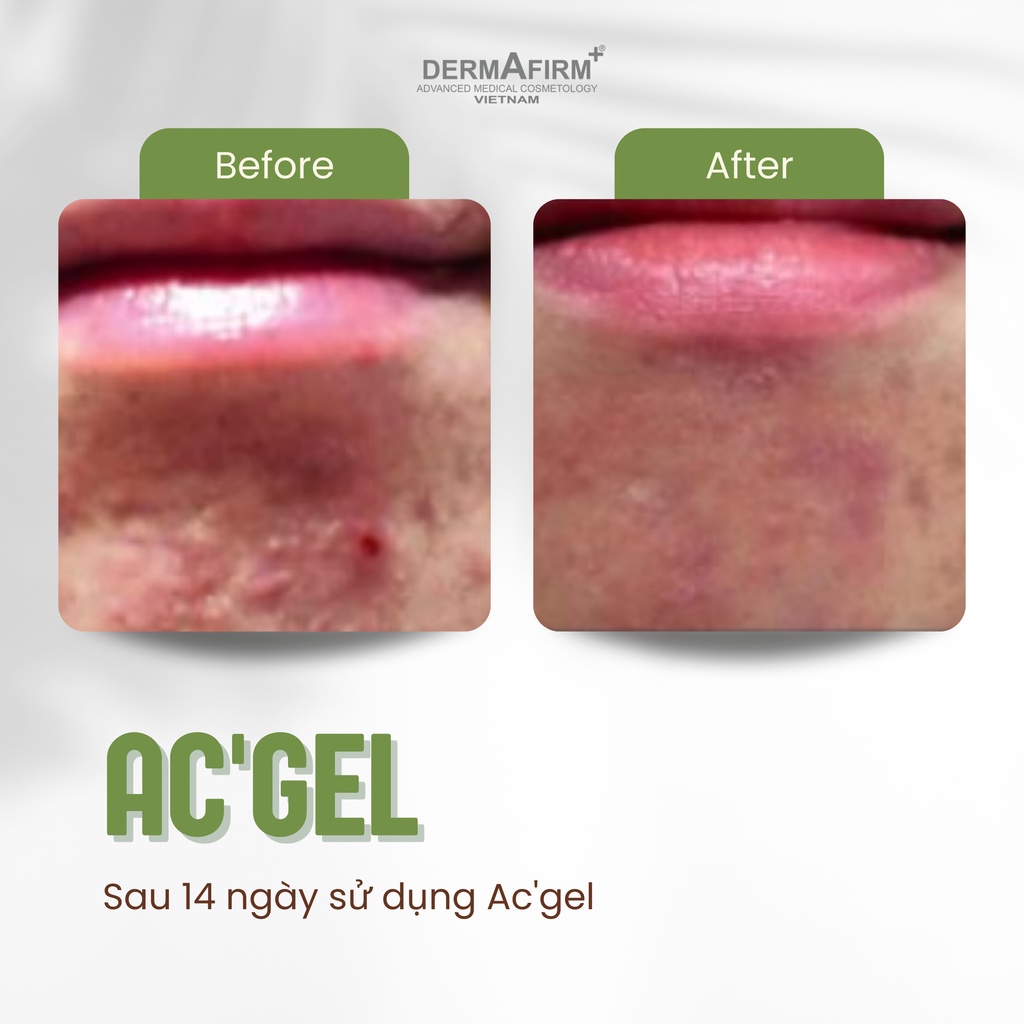 AC' Gel - Gel chấm mụn, cải thiện da mụn