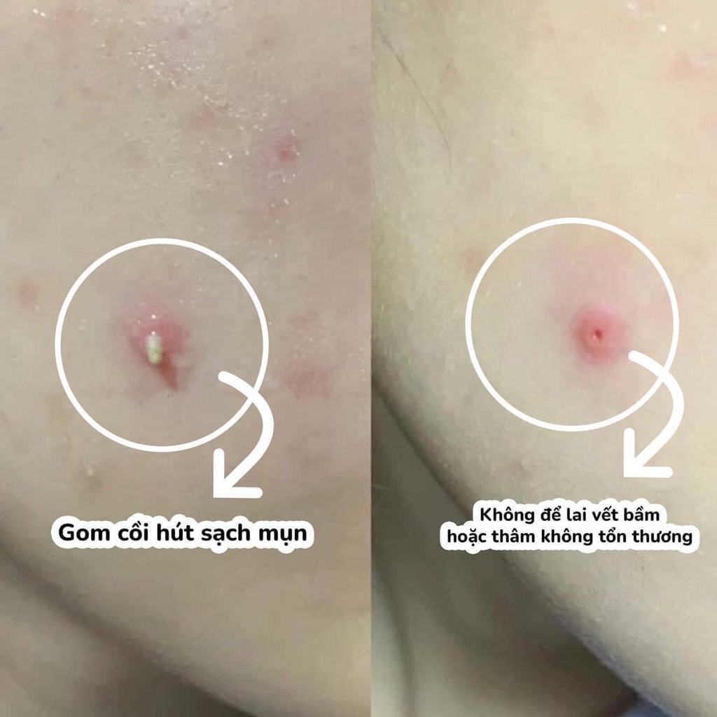 Miếng Dán Mụn Bọc, Mụn Trứng Cá, Mụn Sưng Cosrx Clear Fit Master, Acne Pimple Master, AC Collection Acne Patch