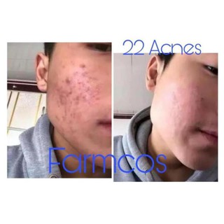 Combo tế bào gốc thực vật 22 acnes