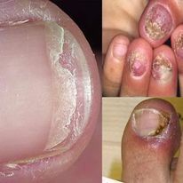 Kem bôi _dalieu . nấm ngoài da, á sừng ...khó chịu