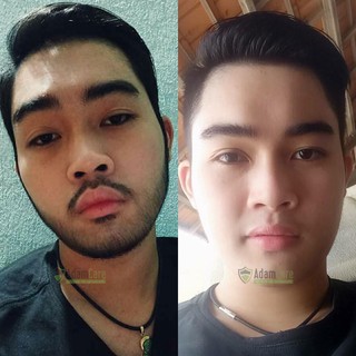 Combo 2 chai minoxidil 5% dạng Foam mọc râu tóc
