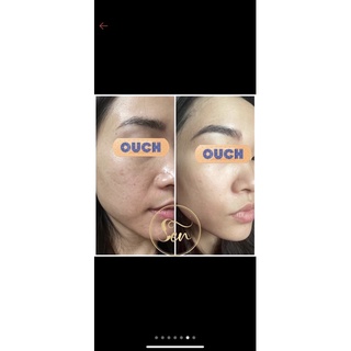 Mặt nạ trị liệu Sen - căng bóng da