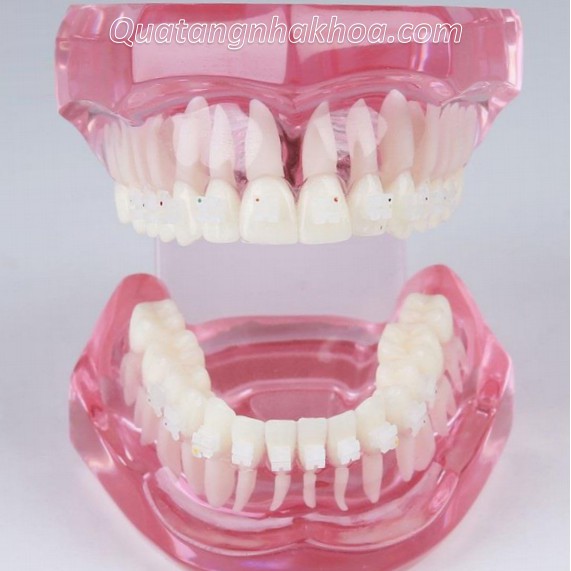 Mẫu hàm tư vấn chỉnh nha mắc cài sứ – mô hình nắn chỉnh răng nha khoa
