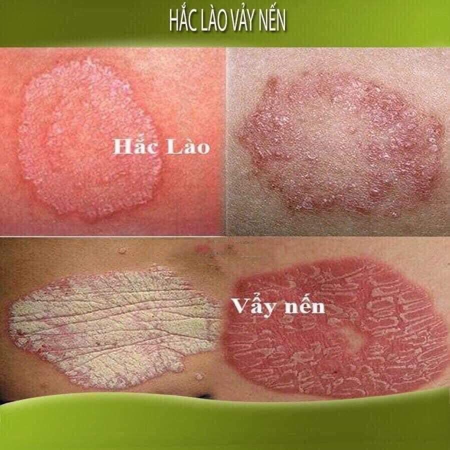 Kem bôi nấm ngứa|mề đay| tổ đỉa| hắc lào| lang ben| vảy nến| á sừng| viem da cơ địa| an toàn cho da| hộp 10Gr
