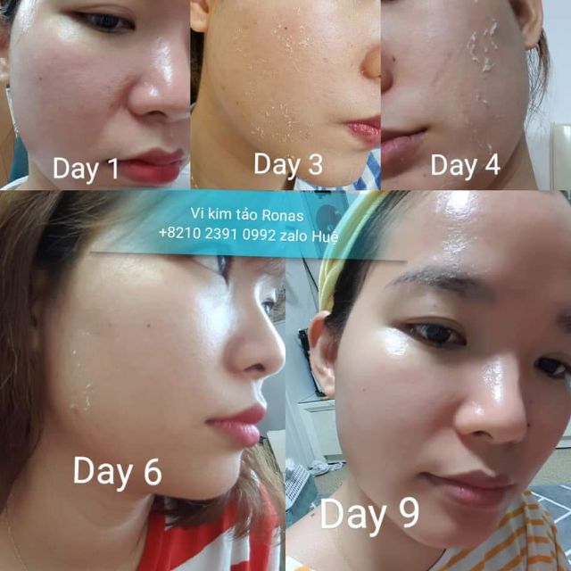 [ Giống như hình] Bộ vi tảo Ronas peel + 1 hộp tế bào gốc Laksmira