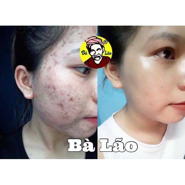 (chính hãng) - SERUM MỤN BÀ LÃO CAO CẤP - BÀ LÃO HỎA TỐC DA THƯỜNG | BigBuy360 - bigbuy360.vn