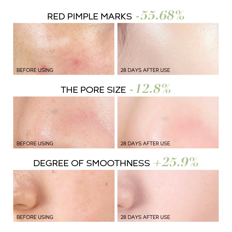 Serum Fenyi lab Hỗ trợ giảm mụn Làm Mịn Da 17ml