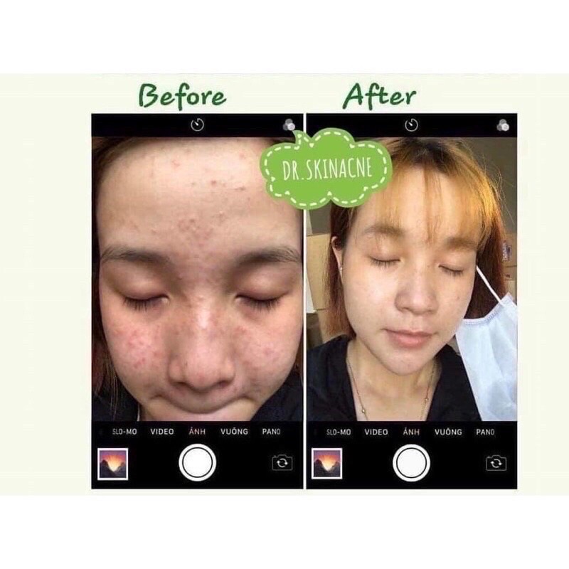 KEM GIẢM MỤN DR.SKINCARE | BigBuy360 - bigbuy360.vn