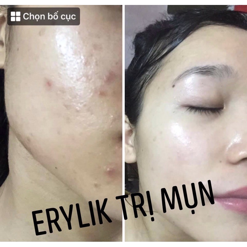 (CHÍNH HÃNG) Kem bôi mụn Erylik 30g