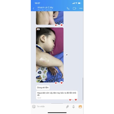 Miếng dán hút mụn, bỏng bô,dịch,loét chống sẹo nhanh lành vết thương