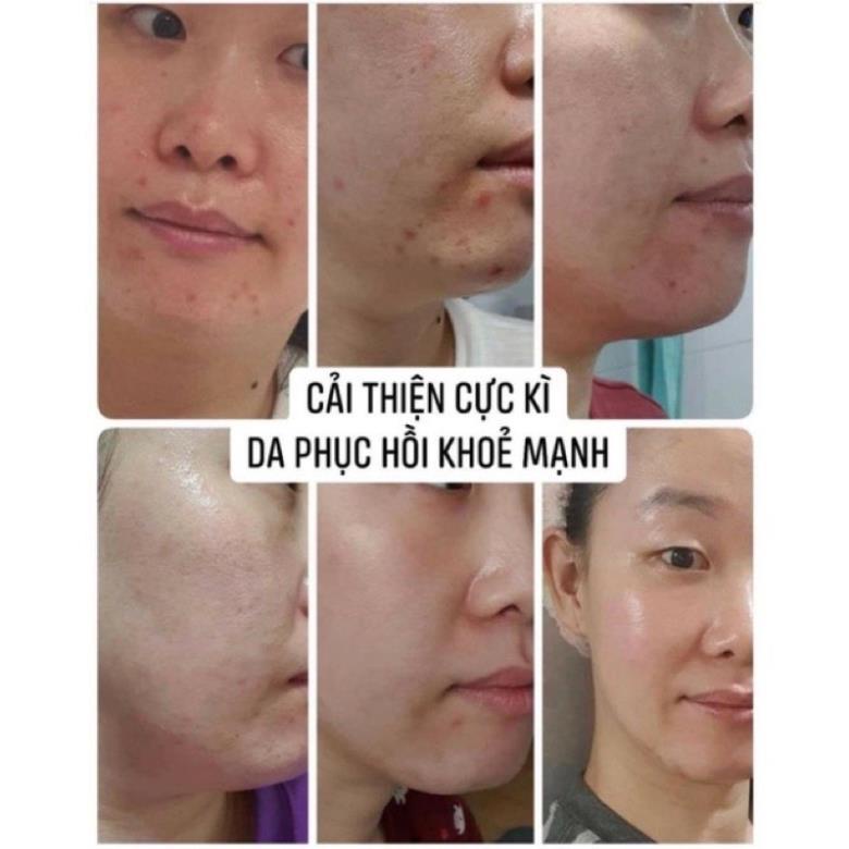 1 vỉ tinh chất tái tạo da Peel CNP RX 2ml