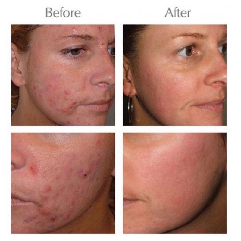 Cam Kết Hàng Chuẩn Kem mụn Opera Australia Anti Acnes