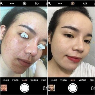 SERUM CHẤM MỤN 12H HUỲNH ĐỖ