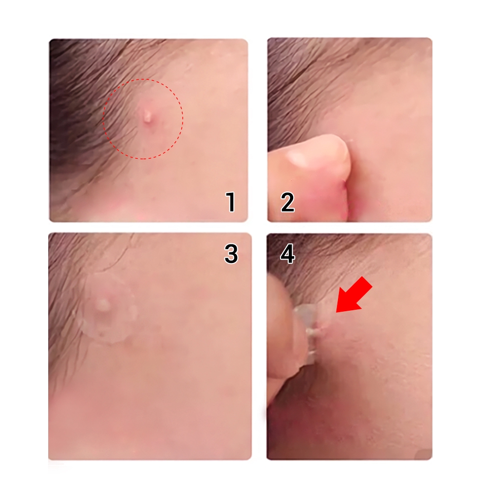 28 night acne patches+25 Daily acne patches LANBENA Vô Hình Dành Cho Mụn Ẩn Giúp Ngừa Thâm Mụn