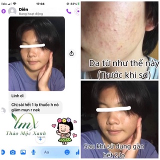 [Sỉ] Thảo Mộc Xanh Mụn 5 lọ 5ml