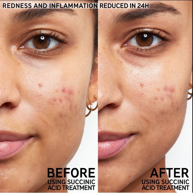 Chấm Mụn The Inkey List Succinic Acid Acne Treatment 15ml | BigBuy360 - bigbuy360.vn