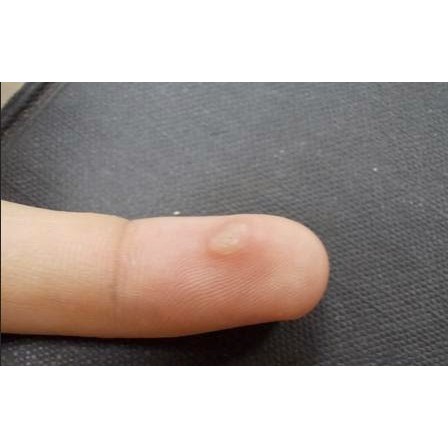 Dứt điểm mụn cóc lòng bàn tay, bàn chân | BigBuy360 - bigbuy360.vn