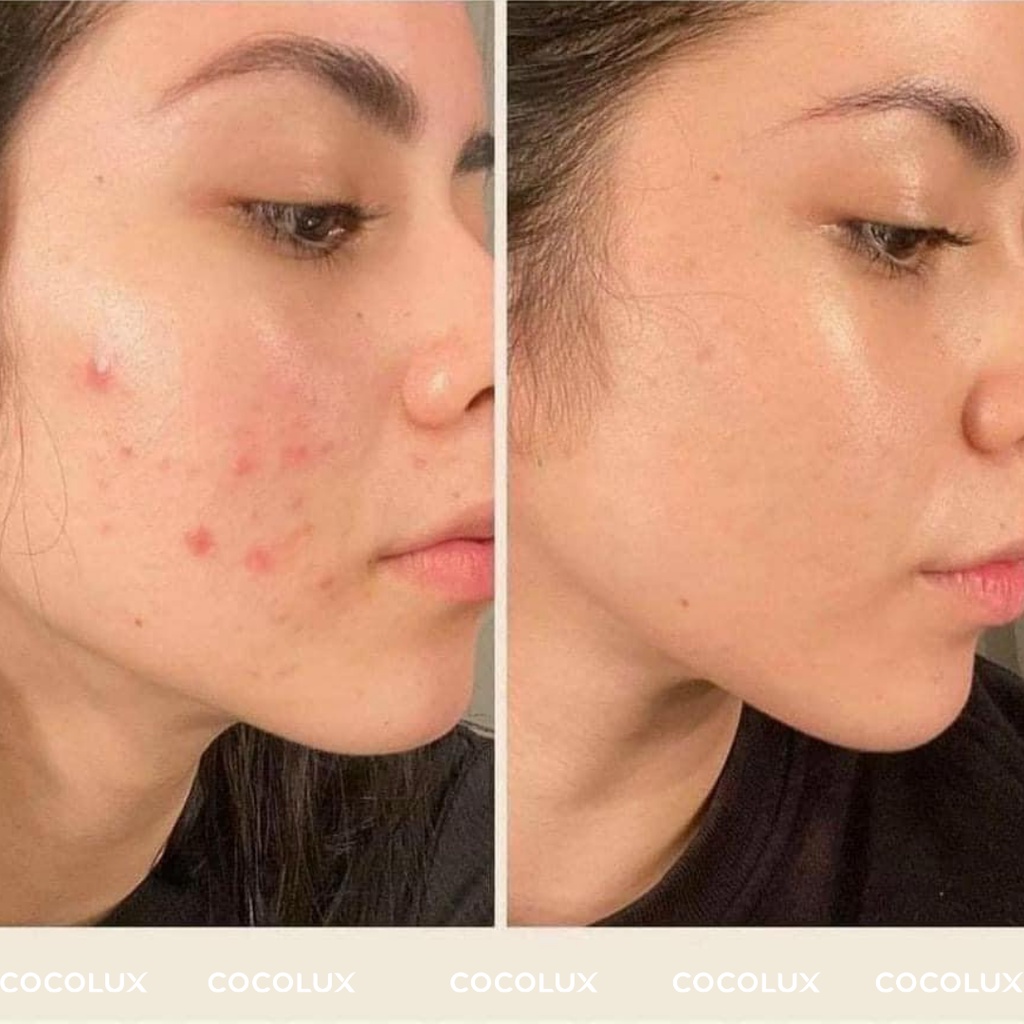 Gel Giảm Mụn, Giảm Thâm DERMA FORTE 15G [COCOLUX]