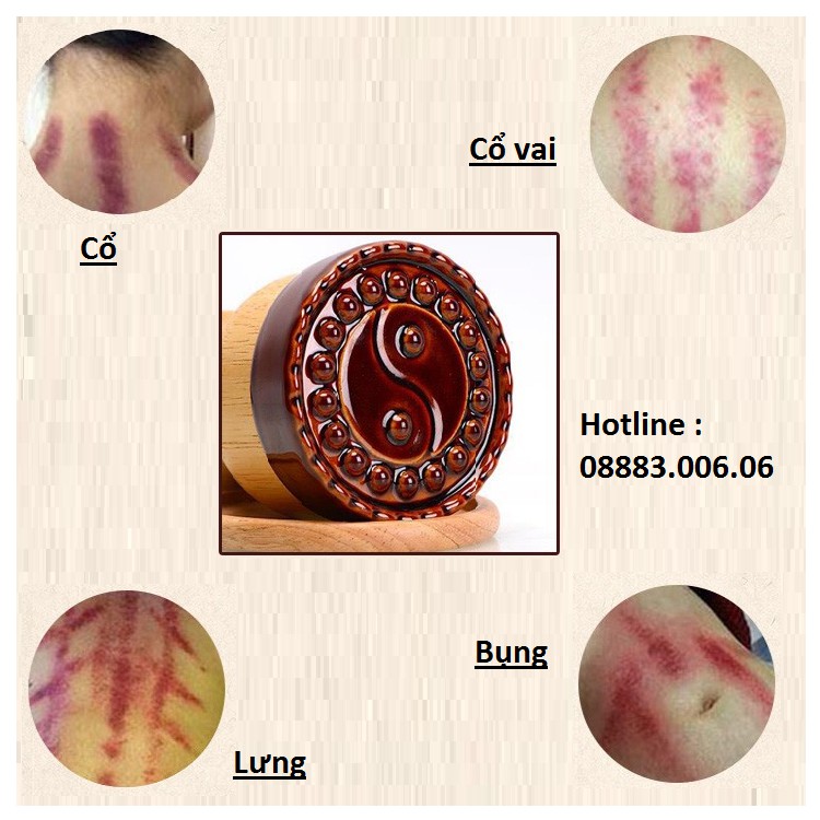 CỐC NHIỆT TRỊ LIỆU - CỐC NHIỆT MASSAGE TRỊ LIỆU