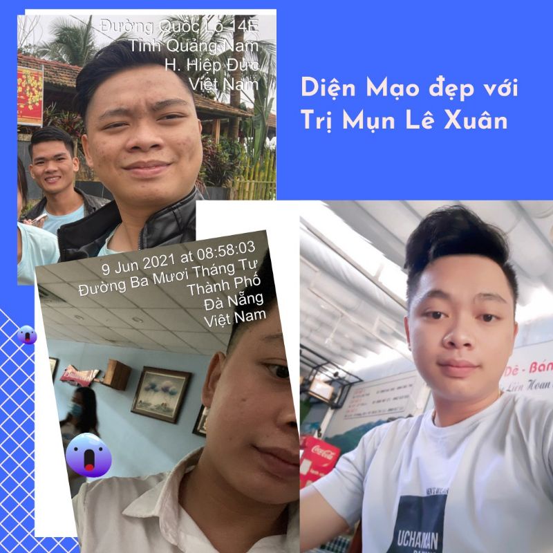 Ngừa mụn Lê Xuân🍀thảo dược đông y lê xuân🍀loại bỏ mụn trứng cá, mụn ẩn, mụn viêm,… | BigBuy360 - bigbuy360.vn